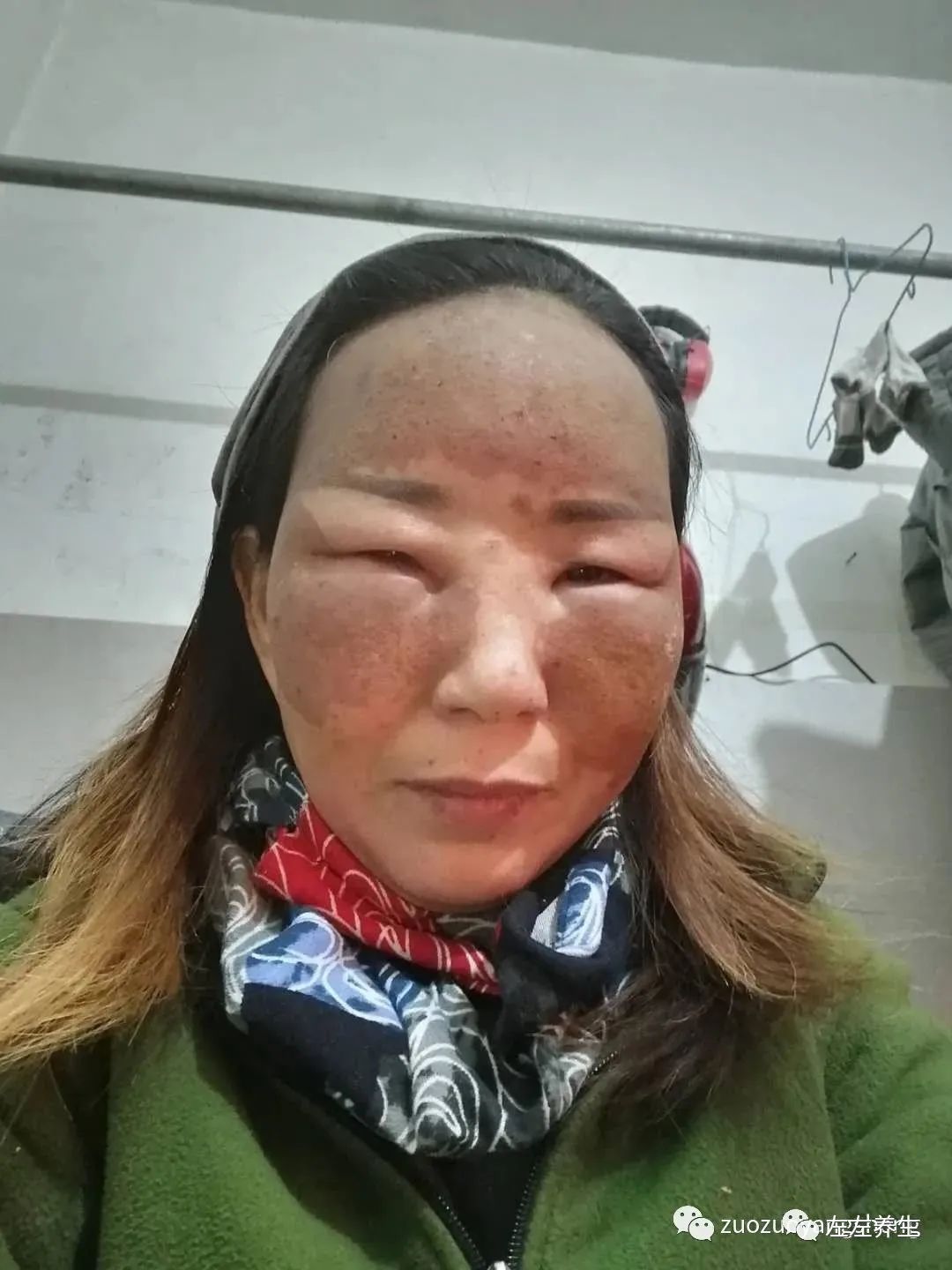 案例分享：臉上嚴重皮膚過敏調理案例