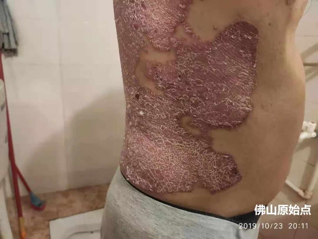 原始點調理十年牛皮癬案例