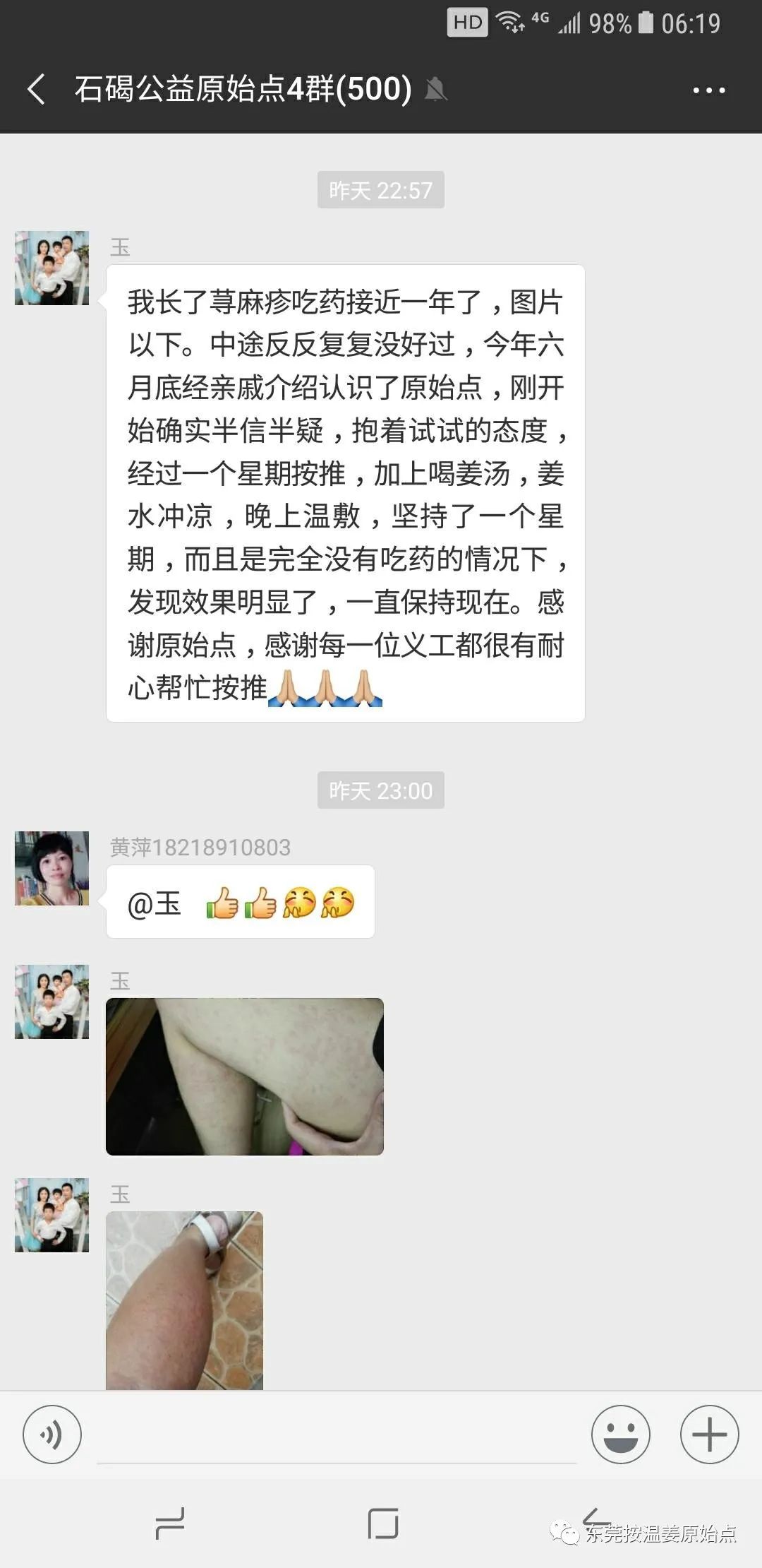 蕁麻疹
