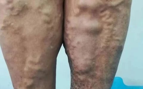 原始點案例:靜脈曲張案例集-七不姜 生姜養生網-明德CSA生態姜園&明安農業