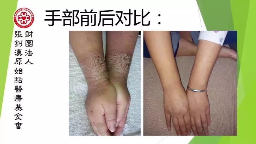 嚴重濕疹案例(青島)2018-1-24-七不姜 生姜養生網-明德CSA生態姜園&明安農業
