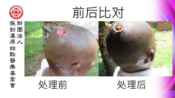 頭部潰爛案例（簡體版）