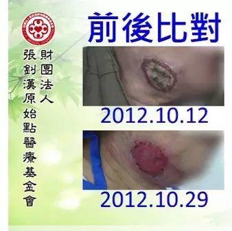 干癬案例(血燥李先生)(簡體版)-七不姜 生姜養生網-明德CSA生態姜園&明安農業