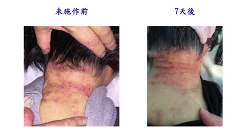 嚴重皮膚病案例