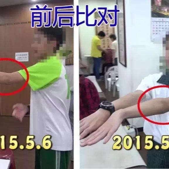 手骨裂21天恢復案例(簡體版)-七不姜 生姜養生網-明德CSA生態姜園&明安農業