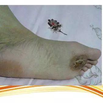 雞眼用原始點處理9天痊愈案例(簡體版)-七不姜 生姜養生網-明德CSA生態姜園&明安農業