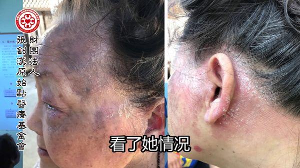 牛皮癬案例（美國）