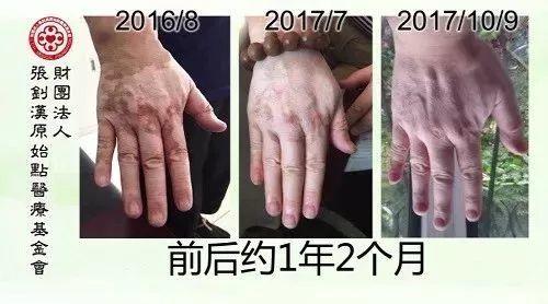 白癜風案例--2017.11最新案例-七不姜 生姜養生網-明德CSA生態姜園&明安農業