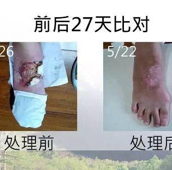 腳部燙傷案例(熱湯)(簡體版)-七不姜 生姜養生網-明德CSA生態姜園&明安農業