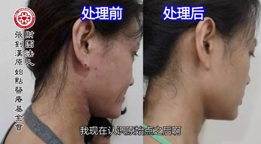 異位性皮膚炎案例(王小姐)(簡體版)-2017.8最新案例-七不姜 生姜養生網-明德CSA生態姜園&明安農業
