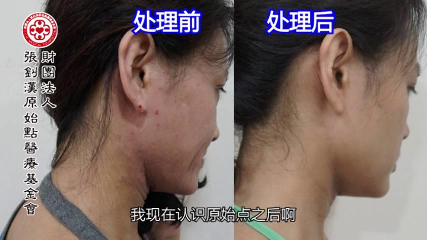 異位性皮膚炎案例(王小姐)（簡體版）-2017.8最新案例