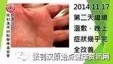 干手癥案例(美國舊金山)-七不姜 生姜養生網-明德CSA生態姜園&明安農業