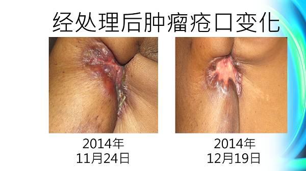 乳癌案例（若斯玲）（簡體版）