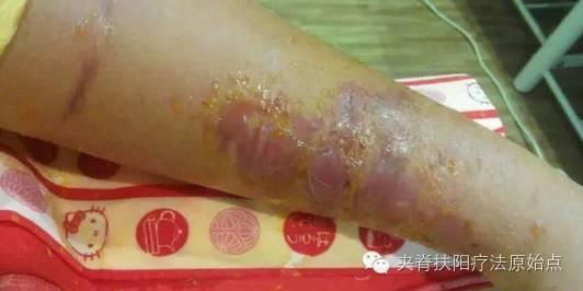 案例分享:原始點調理蛇毒的成功案例-七不姜 生姜養生網-明德CSA生態姜園&明安農業