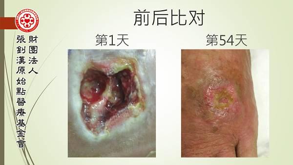 腳部傷口案例（簡體版）