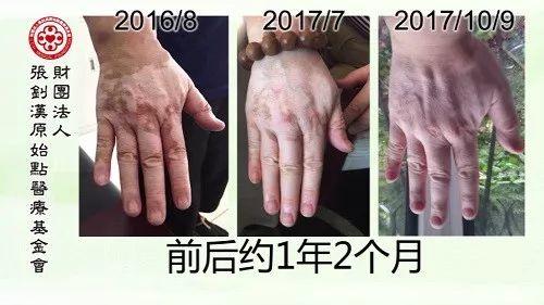 白癜風案例--2017.11最新案例