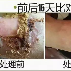 腳燙傷15天完全修復案例(簡體版)-七不姜 生姜養生網-明德CSA生態姜園&明安農業