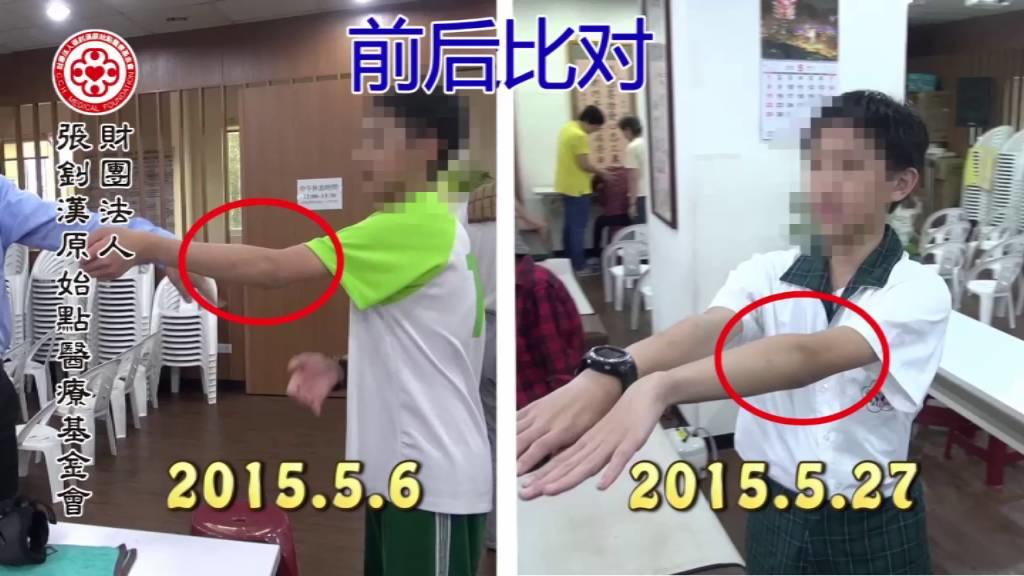 手骨裂21天恢復案例（簡體版）