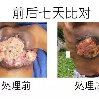 乳癌七天大幅改善案例(46歲辛巴威)(簡體版)-七不姜 生姜養生網-明德CSA生態姜園&明安農業