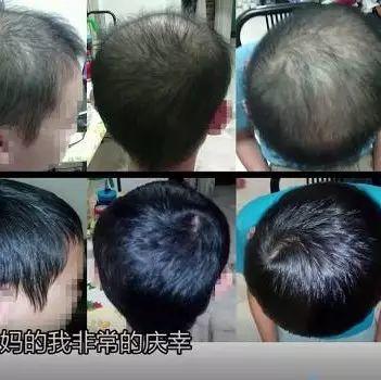 少年脫發案例(馬國)(簡體版)-七不姜 生姜養生網-明德CSA生態姜園&明安農業