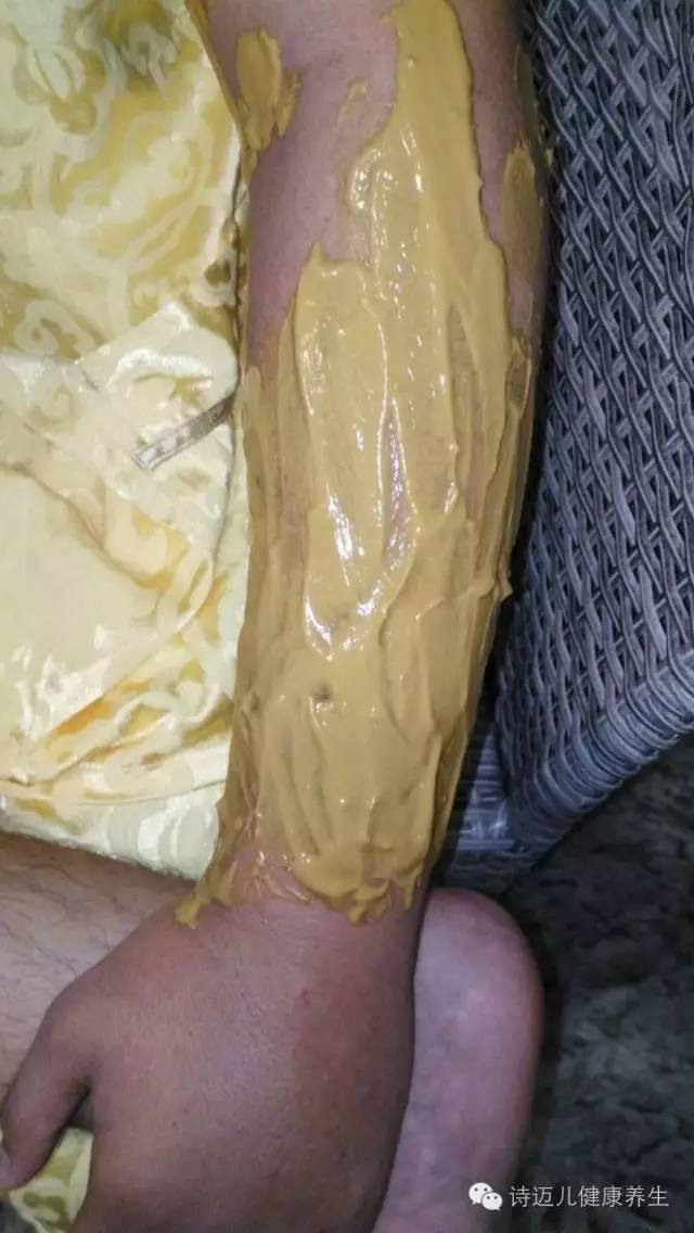 案例分享：原始點調理蛇毒的成功案例