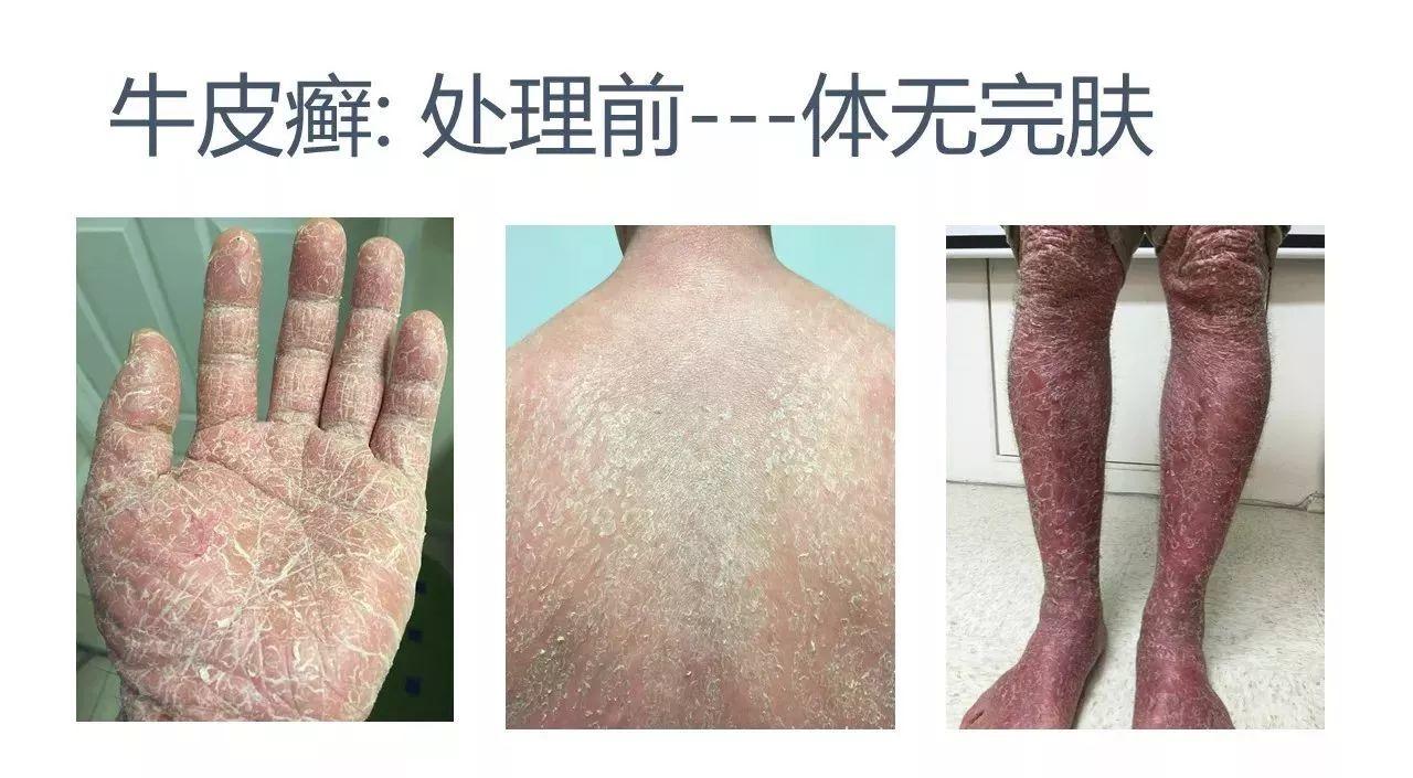 牛皮癬案例(日本人)(后續追蹤)-七不姜 生姜養生網-明德CSA生態姜園&明安農業