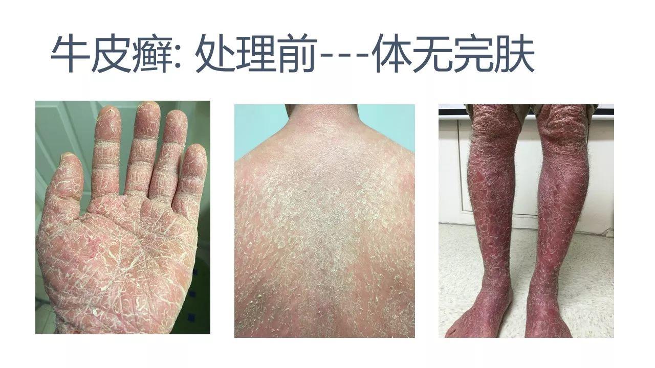 牛皮癬案例（日本人）（后續追蹤）