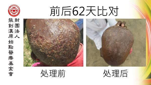 頭部感染案例（辛巴威小女孩探訪）（簡體版）