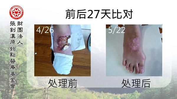 腳部燙傷案例（熱湯）（簡體版）
