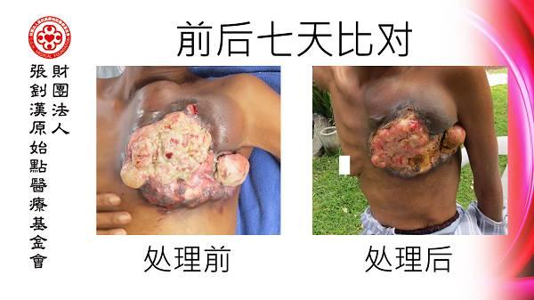 乳癌七天大幅改善案例（46歲辛巴威）（簡體版）