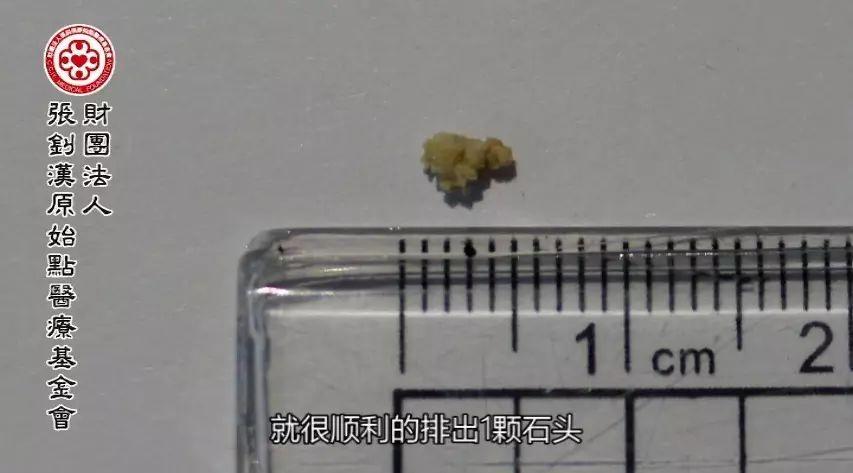 結石自然排出案例-2017.8最新案例-七不姜 生姜養生網-明德CSA生態姜園&明安農業