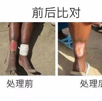 腳部皮膚癌案例(辛巴威探訪)(簡體版)-七不姜 生姜養生網-明德CSA生態姜園&明安農業
