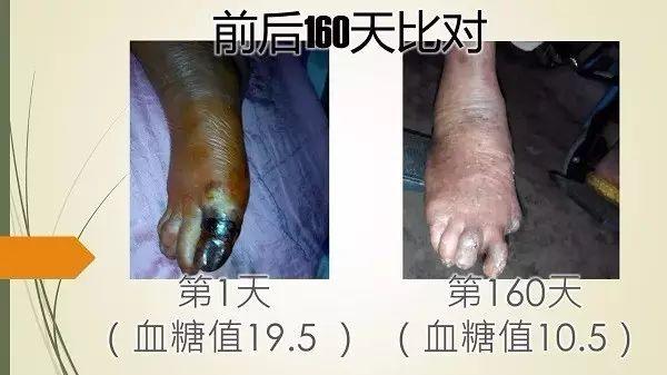 廣西黑腳阿嫲（糖尿病）案例（簡體版）