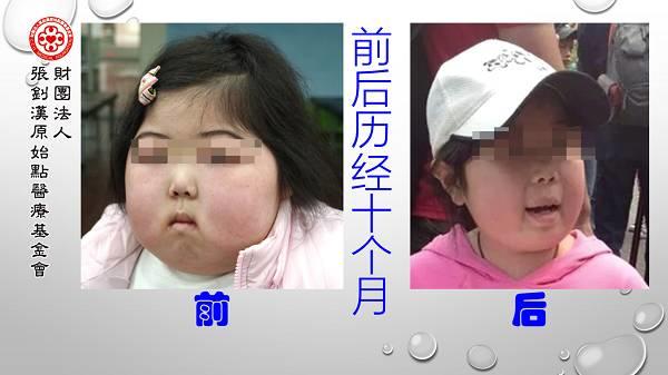 腎病癥候群案例（簡體版）