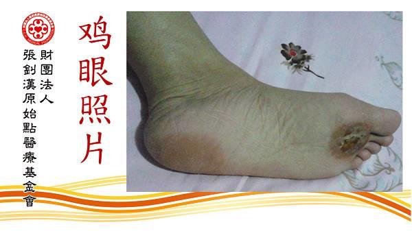 雞眼用原始點處理9天痊愈案例（簡體版）