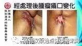 乳癌案例(若女士)-七不姜 生姜養生網-明德CSA生態姜園&明安農業