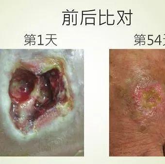 腳部傷口案例(簡體版)-七不姜 生姜養生網-明德CSA生態姜園&明安農業