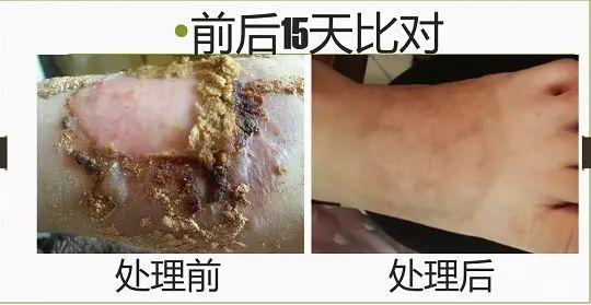 腳燙傷15天完全修復案例（簡體版）