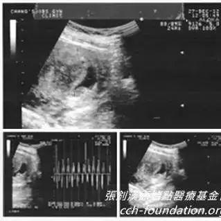 胎死腹中案例(臺灣)(簡體版)-七不姜 生姜養生網-明德CSA生態姜園&明安農業