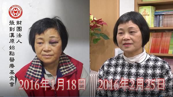 車禍頭部外傷出血案例（簡體版）