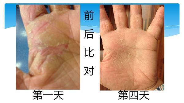 干手癥24小時溫敷4天痊愈（簡體版）