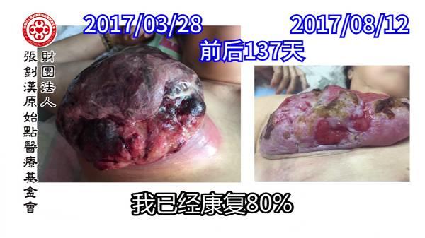 乳癌案例（馬來西亞）--2017.11最新案例
