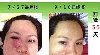 鼻腔惡性淋巴瘤案例-七不姜 生姜養生網-明德CSA生態姜園&明安農業