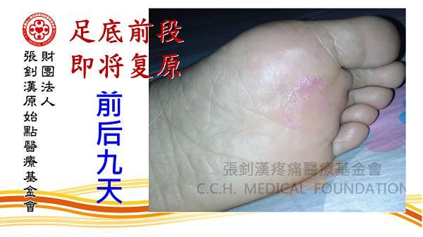 雞眼用原始點處理9天痊愈案例（簡體版）