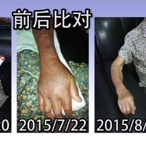 手骨折案例(老人)(簡體版)-七不姜 生姜養生網-明德CSA生態姜園&明安農業