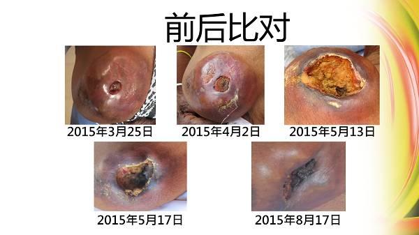 82歲婆婆乳癌案例(簡體版)-七不姜 生姜養生網-明德CSA生態姜園&明安農業