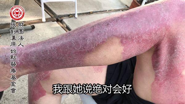 牛皮癬案例（美國）