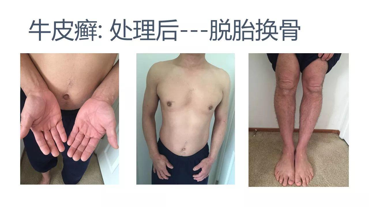 牛皮癬案例（日本人）（后續追蹤）