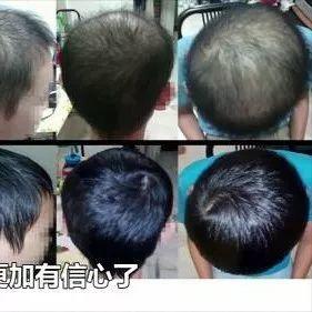 少年脫發案例(簡體版)-七不姜 生姜養生網-明德CSA生態姜園&明安農業