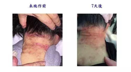 嚴重皮膚病案例-七不姜 生姜養生網-明德CSA生態姜園&明安農業